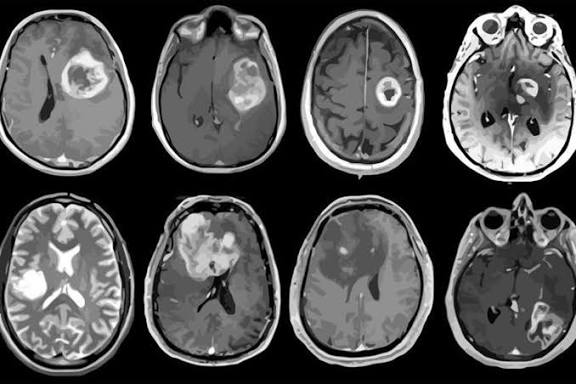 Nuevo tratamiento experimental logra resultados asombrosos contra el agresivo cáncer cerebral glioblastoma